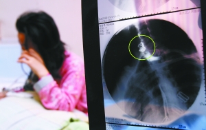 假牙上的鋼絲刺破食管，而薄薄的食道壁緊貼主動脈血管，極易造成血管破裂