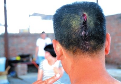 崔先生頭部受傷。京華時報記者趙思衡攝/視頻