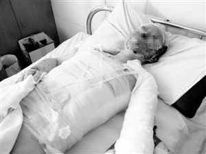 周小姐的頭、頸、軀干、四肢均被燒傷，其中面部燒傷最為嚴(yán)重。