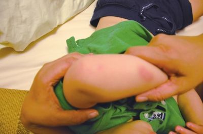 孩子身上有多處明顯傷痕。京華時報讀者供圖