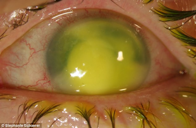 恐怖慎入！隱形眼鏡致英女子摘除眼球