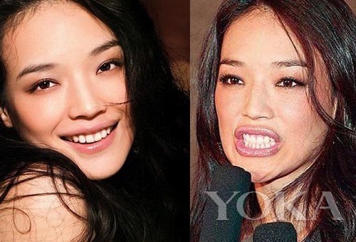 牙齒凸出，口輪肌過于松弛