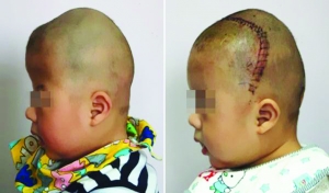 術前（左），術后（右）