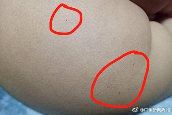 據(jù)多名紅黃藍(lán)(新天地分園)家長(zhǎng)反映，孩子腿部、屁股、腋下出現(xiàn)針眼。
