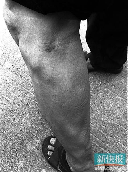 傷者身上遺留的彈痕。