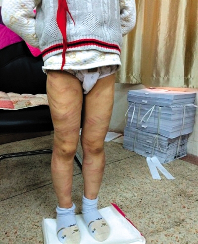 4月3日晚，微博網(wǎng)友“@朝廷半日閑”發(fā)圖文微博展示男童被虐待的慘狀。 微博截圖