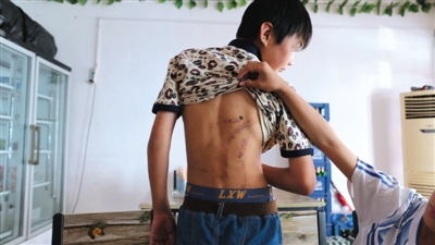 　昨日，奶西村，被打的小剛后背上條條瘀痕依然明顯。