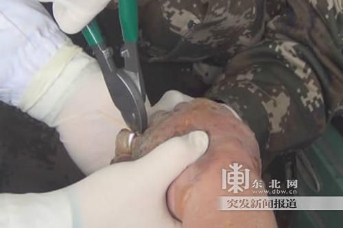 正在拆除戒指。