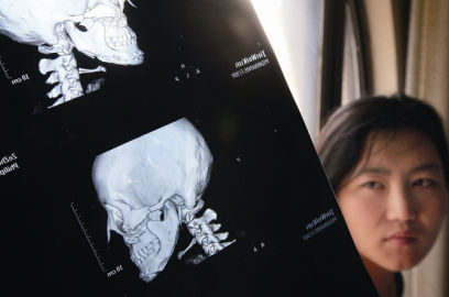 國內(nèi)醫(yī)院CT顯示，如今靳魏坤的鼻子假體是歪的，連下巴也是歪的