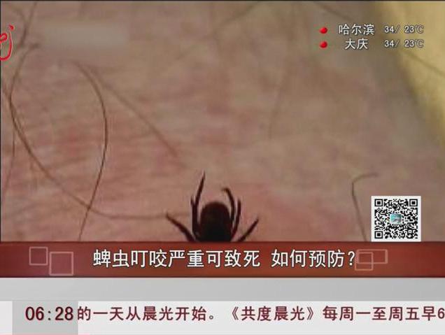 蜱蟲叮咬嚴(yán)重可致死如何預(yù)防？